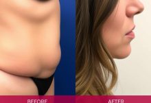 لیپوساکشن چیست؟ عوارض و مزایا، هزینه و مراقبت ها