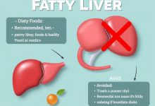رژیم کبد چرب: غذاهای مفید، ممنوعه‌ها و راهکارهای درمان